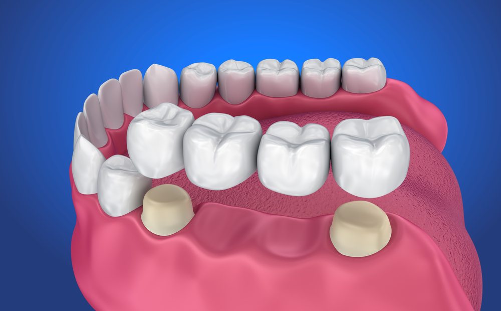 Bọc Răng Sứ - nhakhoadongnam.com: Giải Pháp Hoàn Hảo Cho Nụ Cười Tự Tin image-1748276309389