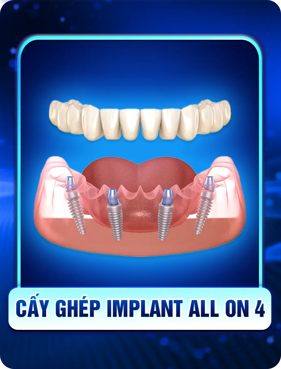 Cấy Ghép Implant - nhakhoadongnam.com: Giải Pháp Trồng Răng Hiện Đại Và Hiệu Quả image-1748276119884