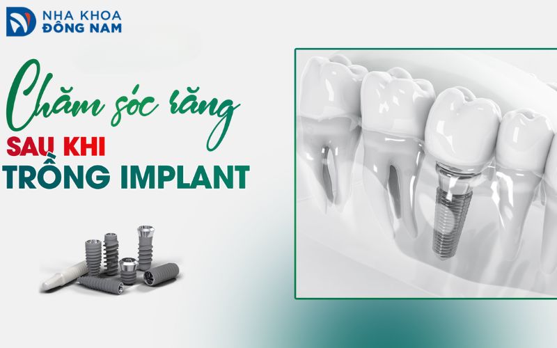 Cấy Ghép Implant - nhakhoadongnam.com: Giải Pháp Trồng Răng Hiện Đại Và Hiệu Quả image-1748276120835