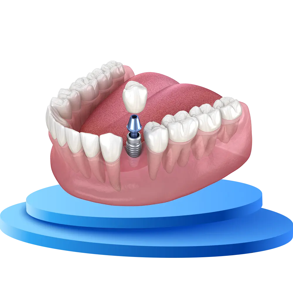 Cấy Ghép Implant - nhakhoadongnam.com: Giải Pháp Tối Ưu Cho Răng Mất image-1748276228523