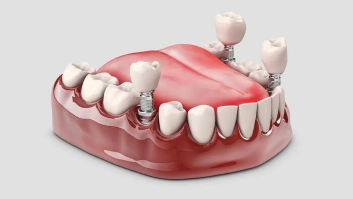 Cấy Ghép Implant - nhakhoadongnam.com: Giải Pháp Tối Ưu Cho Răng Mất image-1748276229333