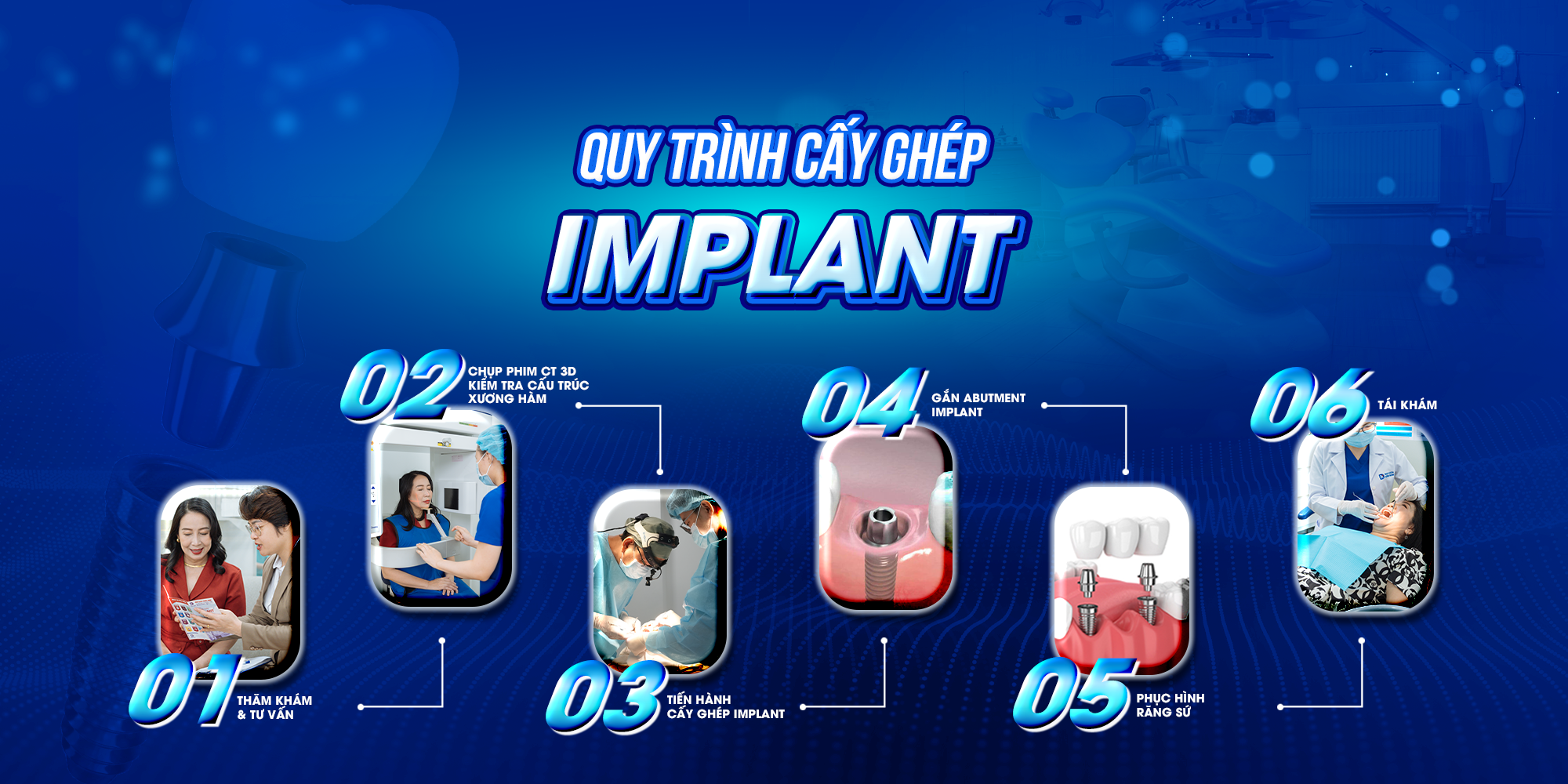 Cấy Ghép Implant - nhakhoadongnam.com: Giải Pháp Tối Ưu Cho Răng Mất image-1748276231885