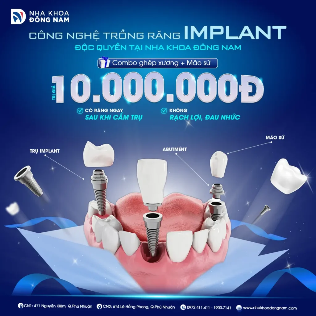 Cấy Ghép Implant - nhakhoadongnam.com: Giải Pháp Tối Ưu Cho Răng Mất image-1748276240675