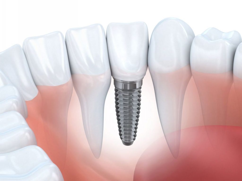 Cấy Ghép Implant - nhakhoadongnam.com: Giải Pháp Tối Ưu Cho Răng Mất image-1748276245990