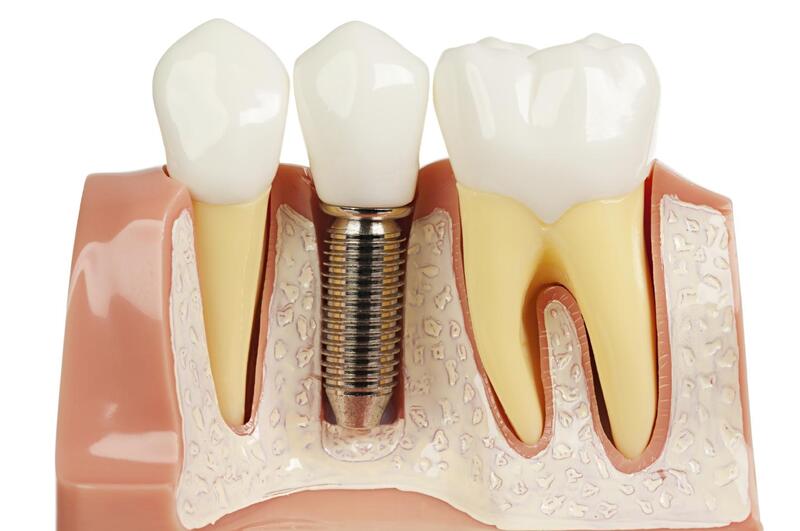 Cấy Ghép Implant - nhakhoadongnam.com: Phương Pháp Phục Hình Răng Hiện Đại Và Hiệu Quả image-1748276482003