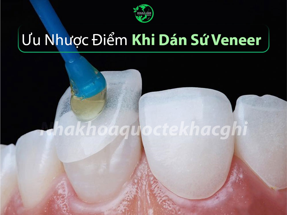 Dán Sứ Veneer - nhakhoadongnam.com: Giải Pháp Thẩm Mỹ Hoàn Hảo Cho Nụ Cười Rạng Rỡ image-1748276389160
