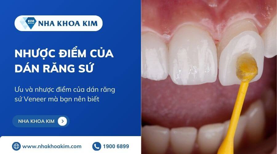 Dán Sứ Veneer - nhakhoadongnam.com: Giải Pháp Thẩm Mỹ Răng Hiện Đại image-1748276541419