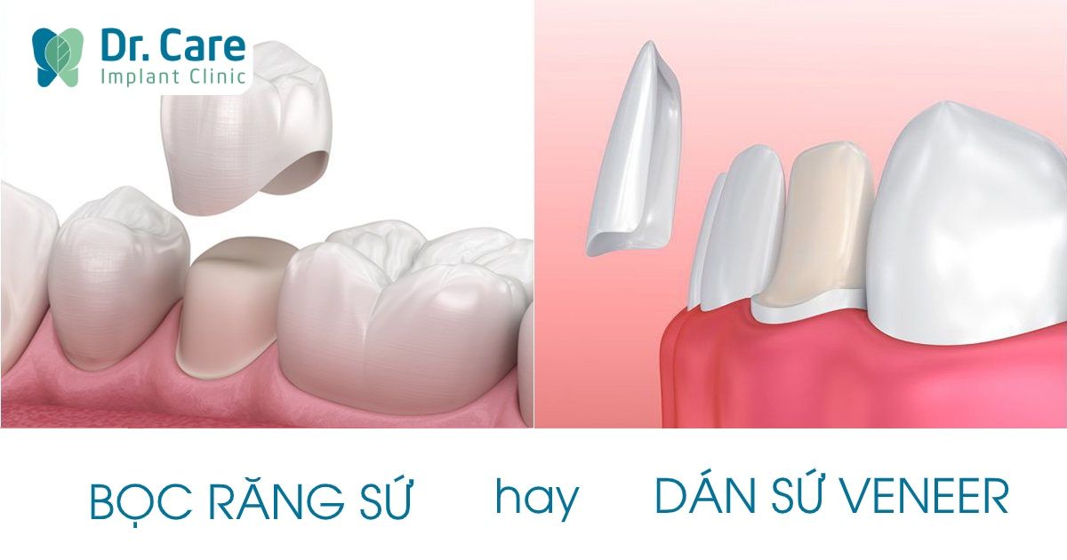 Dán Sứ Veneer - nhakhoadongnam.com: Giải Pháp Thẩm Mỹ Răng Hiện Đại image-1748276543906