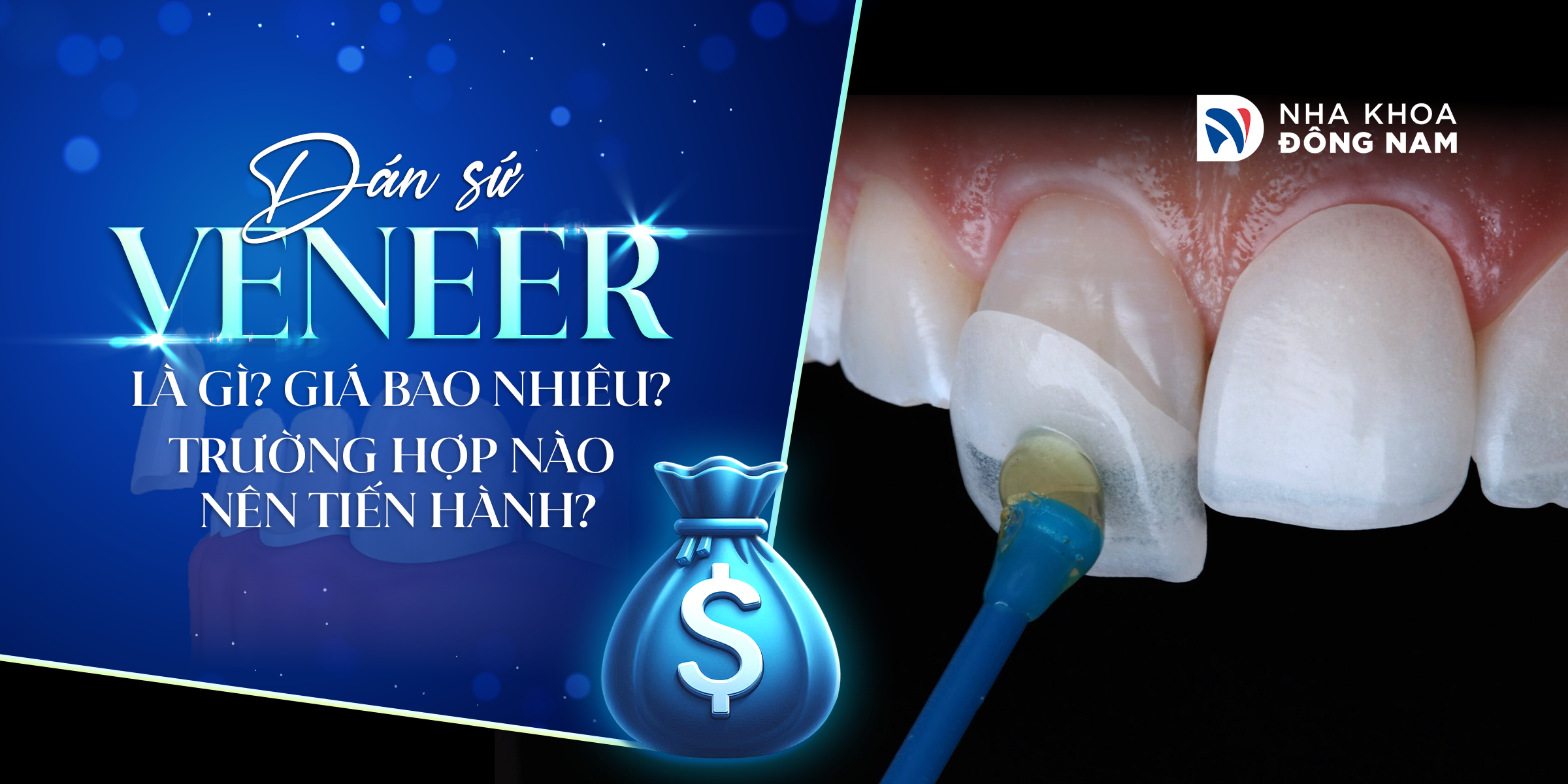 Dán Sứ Veneer - nhakhoadongnam.com: Bí Quyết Cho Nụ Cười Hoàn Hảo image-1748276760750