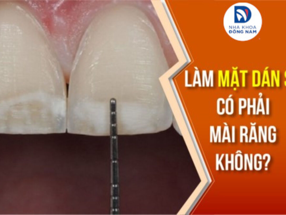 Dán Sứ Veneer - nhakhoadongnam.com: Bí Quyết Cho Nụ Cười Hoàn Hảo image-1748276770979