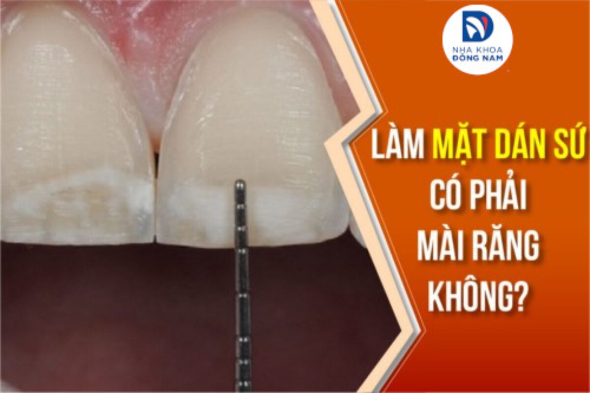 Dán Sứ Veneer - nhakhoadongnam.com: Bí Quyết Cho Nụ Cười Hoàn Hảo image-1748276773330
