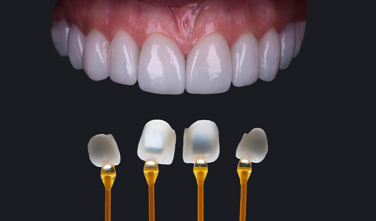 Dán Sứ Veneer - nhakhoadongnam.com: Bí Quyết Cho Nụ Cười Hoàn Hảo image-1748276775491