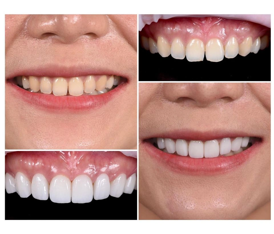 Dán Sứ Veneer - nhakhoadongnam.com: Bí Quyết Cho Nụ Cười Hoàn Hảo image-1748276776525