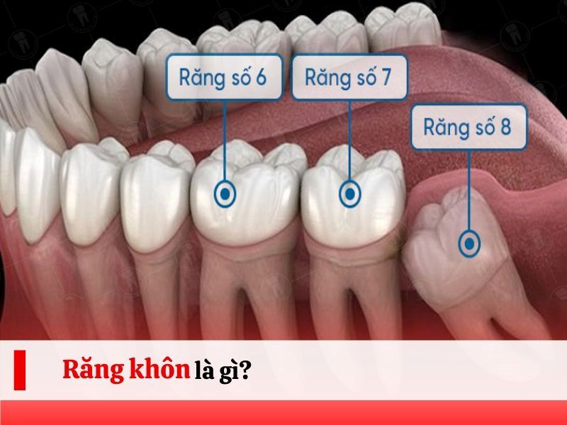 Nhổ Răng Khôn - nhakhoadongnam.com: Những Điều Cần Biết Trước Khi Thực Hiện image-1748276714007