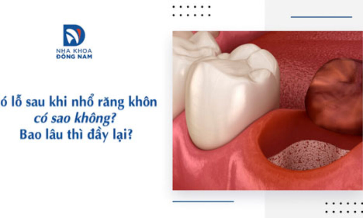 Nhổ Răng Khôn - nhakhoadongnam.com: Những Điều Cần Biết Trước Khi Thực Hiện image-1748276715537