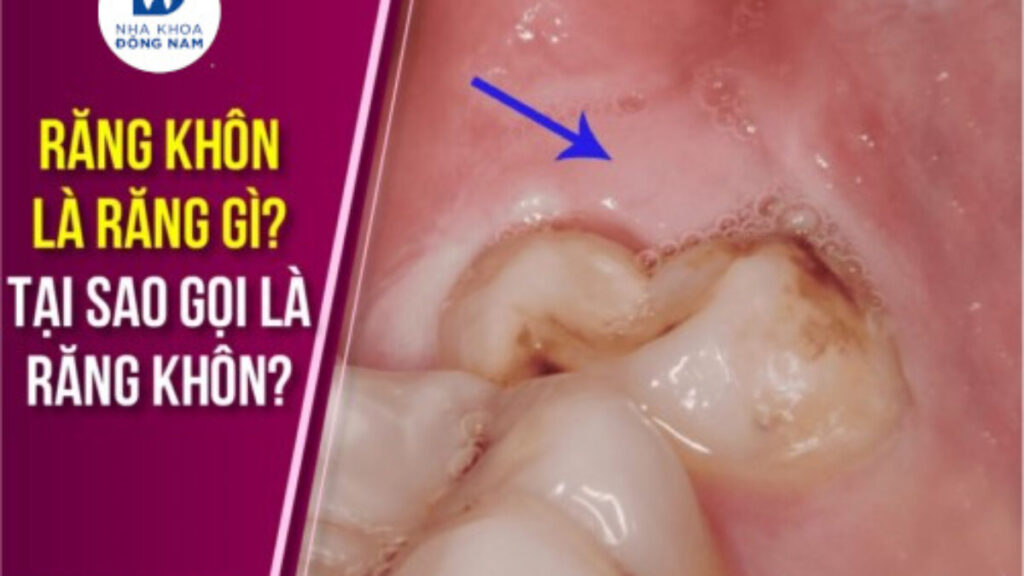 Nhổ Răng Khôn - nhakhoadongnam.com: Những Điều Cần Biết image-1748277121188