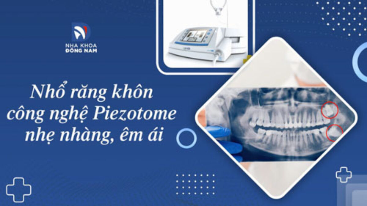 Nhổ Răng Khôn - nhakhoadongnam.com: Những Điều Cần Biết image-1748277125757