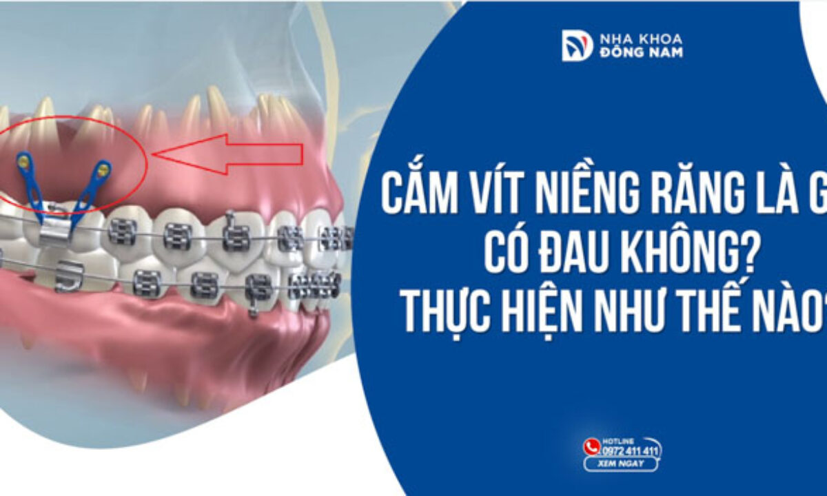 Niềng Răng - nhakhoadongnam.com: Giải Pháp Chỉnh Nha Hiệu Quả Và An Toàn image-1748276542585