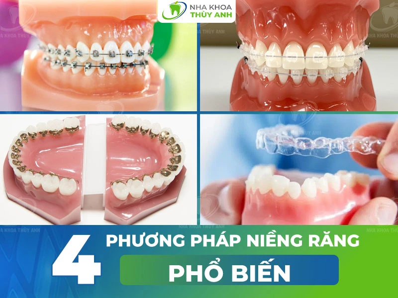 Niềng Răng - nhakhoadongnam.com: Giải Pháp Chỉnh Nha Hiệu Quả image-1748276690383