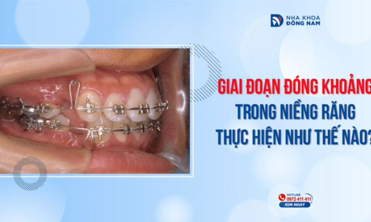 Niềng Răng - nhakhoadongnam.com: Giải Pháp Thẩm Mỹ Và Chức Năng Toàn Diện image-1748276944306