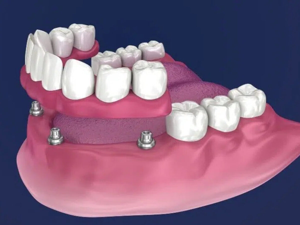 Răng Giả Tháo Lắp - nhakhoadongnam.com: Giải Pháp Phục Hình Hiệu Quả, Tiết Kiệm image-1748276797134