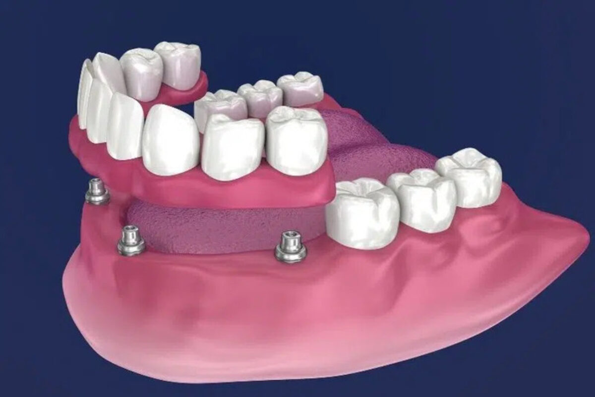 Răng Giả Tháo Lắp - nhakhoadongnam.com: Giải Pháp Phục Hồi Răng Mất An Toàn Và Hiệu Quả image-1748276939051