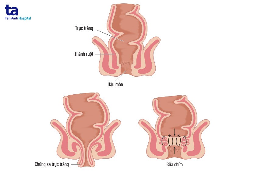Tìm Hiểu Tất Cả Về SA Trực Tuyến: Nguyên Nhân, Dấu Hiệu Và Điều Trị image-1748535519002