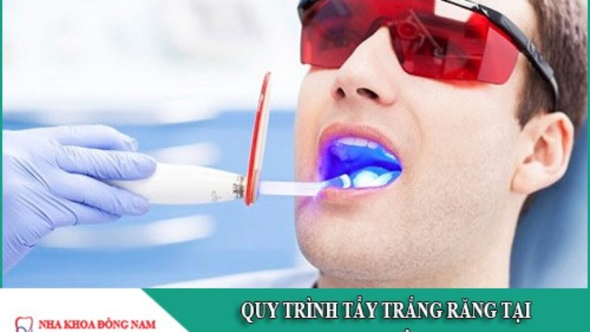 Tẩy Trắng Răng - nhakhoadongnam.com: Những Điều Bạn Cần Biết image-1748276626604