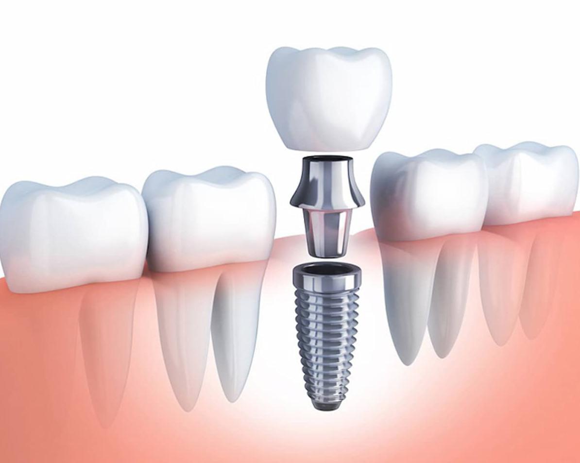 Trồng Răng Implant - nhakhoadongnam.com: Giải Pháp Hiệu Quả Cho Nụ Cười Hoàn Hảo image-1748276195704