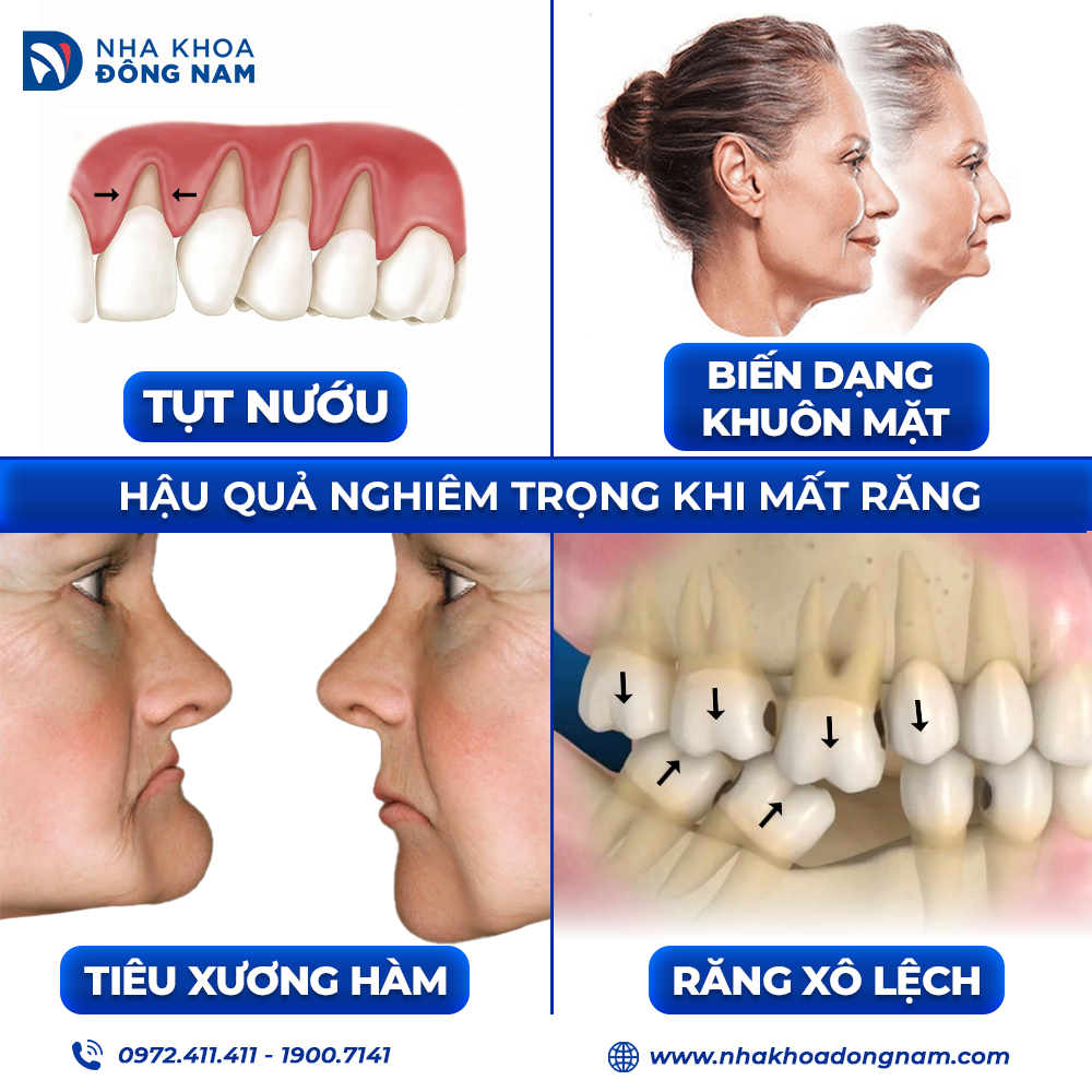 Trồng Răng Implant - nhakhoadongnam.com: Giải Pháp Hiệu Quả Cho Nụ Cười Hoàn Hảo image-1748276196936