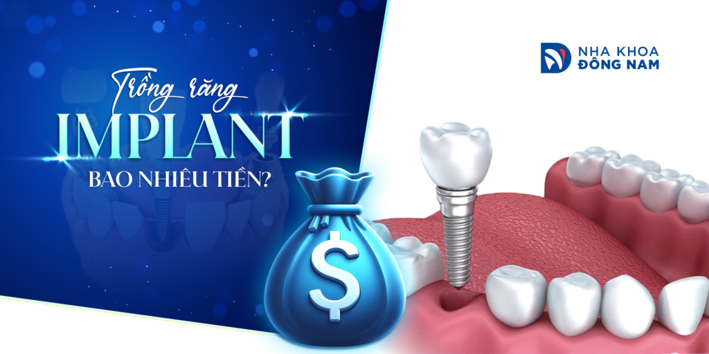 Trồng Răng Implant - nhakhoadongnam.com: Giải Pháp Hiệu Quả Cho Nụ Cười Hoàn Hảo image-1748276198705
