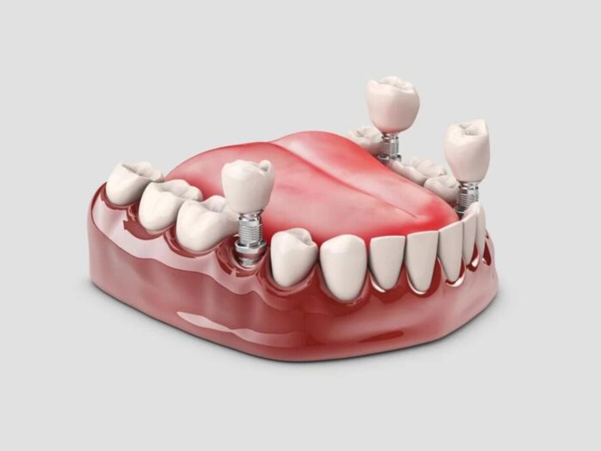 Trồng Răng Implant - nhakhoadongnam.com: Giải Pháp Hiệu Quả Cho Nụ Cười Hoàn Hảo image-1748276201960