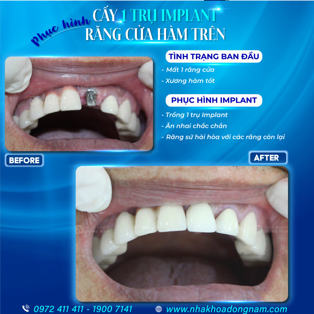 Trồng Răng Implant - nhakhoadongnam.com: Giải Pháp Hiệu Quả Cho Nụ Cười Hoàn Hảo image-1748276203013
