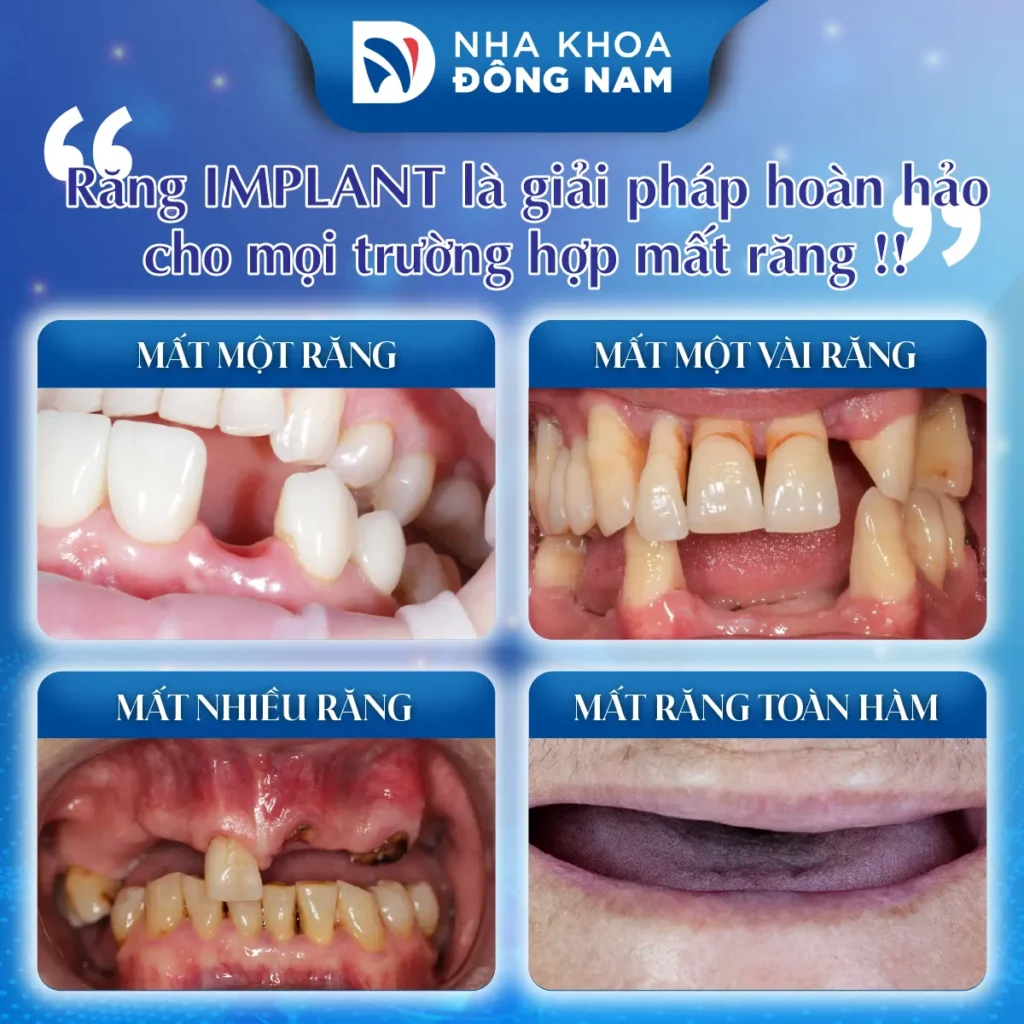 Trồng Răng Implant - nhakhoadongnam.com: Giải Pháp Tối Ưu Cho Mất Răng image-1748276331444