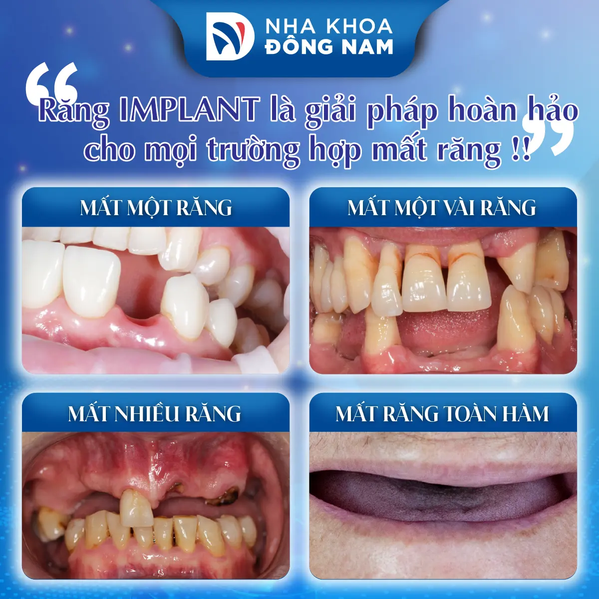 Trồng Răng Implant - nhakhoadongnam.com: Giải Pháp Tối Ưu Cho Mất Răng image-1748276331444