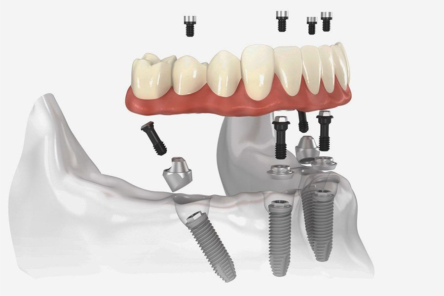 Trồng Răng Implant - nhakhoadongnam.com: Giải Pháp Tối Ưu Cho Mất Răng image-1748276342424